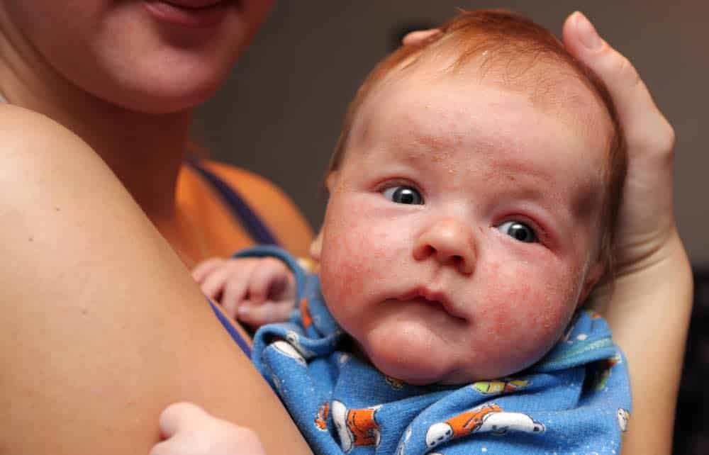 tactiek Demon Play Voorzichtigheid Droge huid bij baby of peuter? Deze tips helpen klachten verminderen